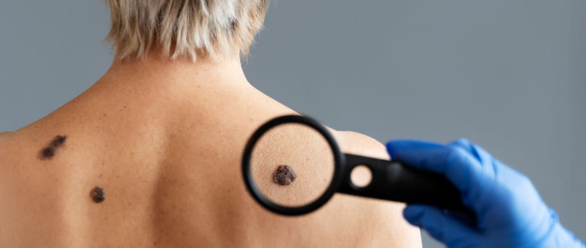 fibromi