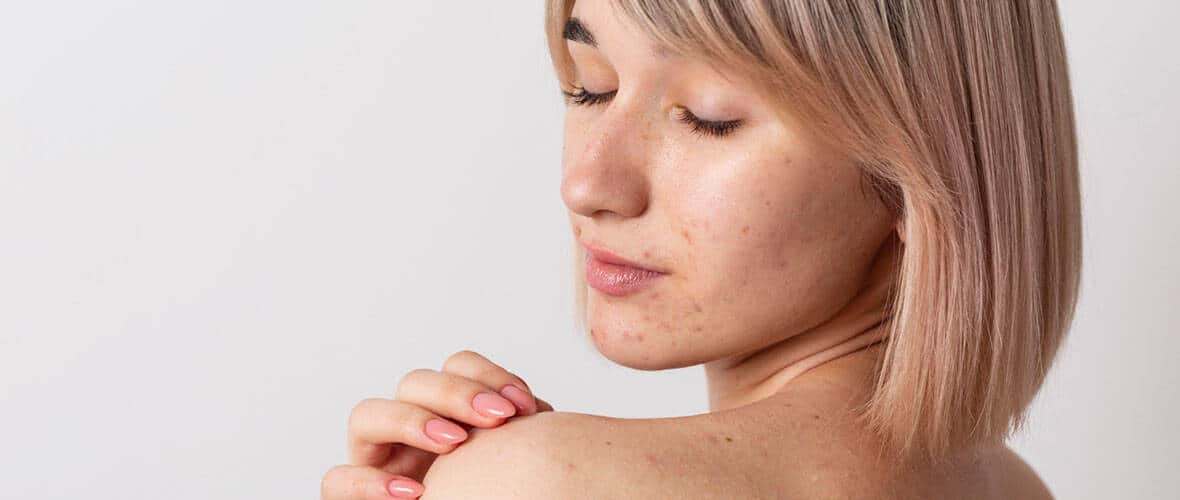 red moles
